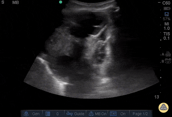 Malignant Pleural Effusion