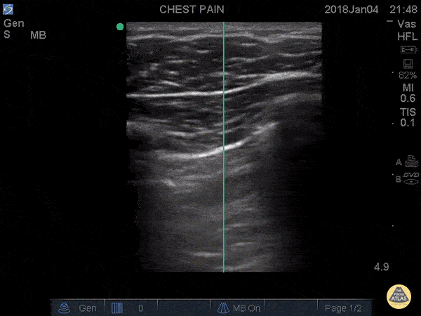 Occult pneumothorax: tube or observe?