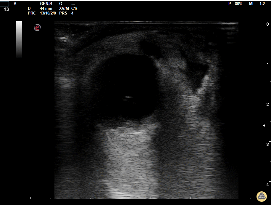 Orbital Abscess