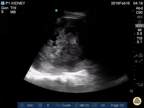 Traumatic Kidney Hematoma