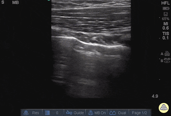 Pulmonary Contusion