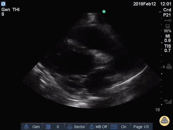 Decreased EF (Parasternal Long)