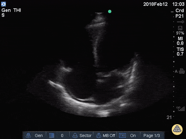 Reduced EF (Apical 4 Chamber)