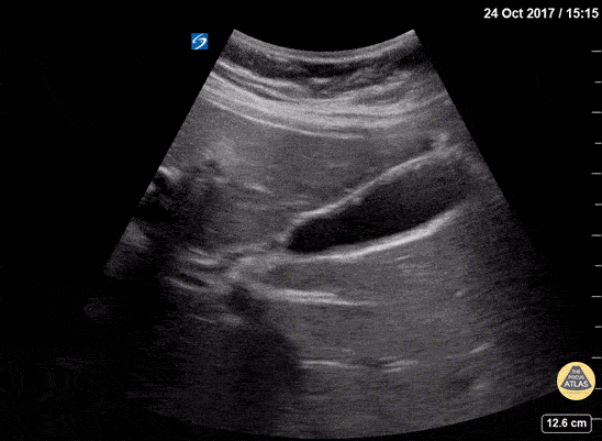 Adenomyomatosis
