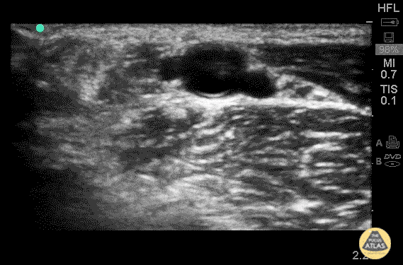 Radial Artery Thrombus (Pre/Post TPA)