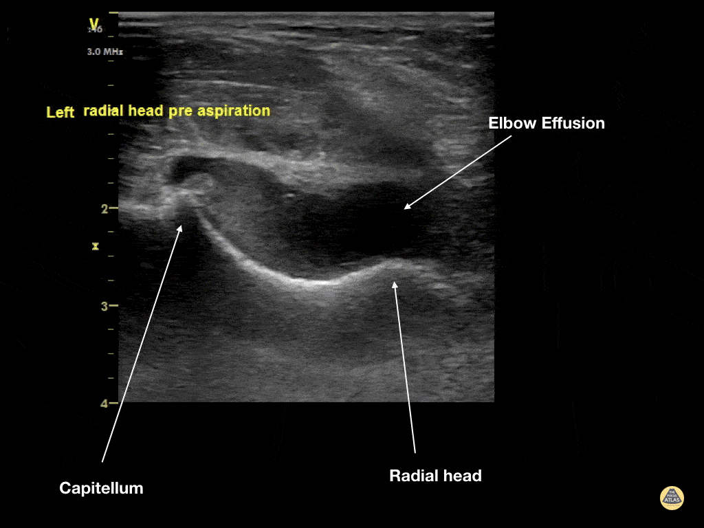 Elbow Effusion (Traumatic)