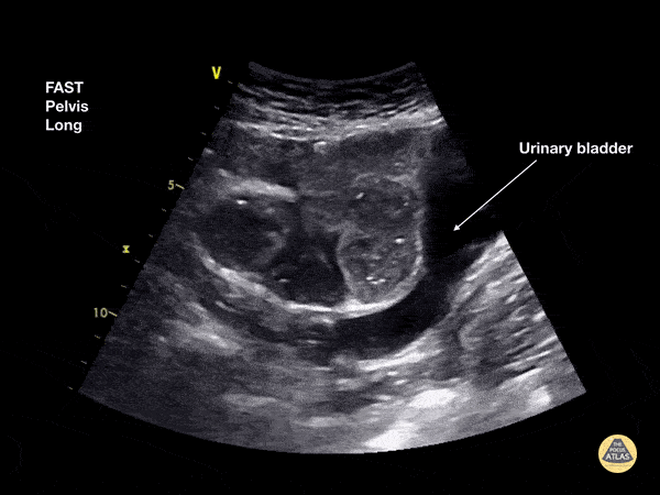 Small Bowel Obstruction