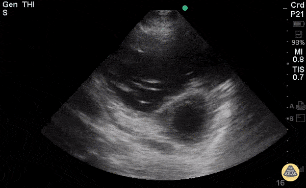Right-Sided Heart Failure (PSAX)