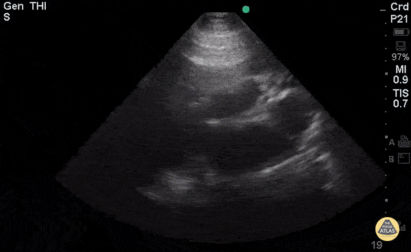 Right-Sided Heart Failure (PLAX)