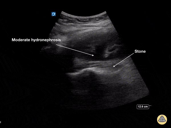 Moderate Hydronephrosis