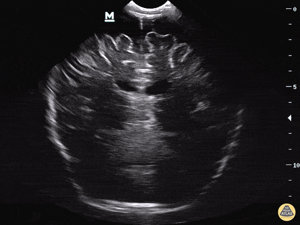 Clip 1: You notice significant enlargement of the extra axial space seen most clearly in the 12 o’clock position above the interhemispheric fissure.