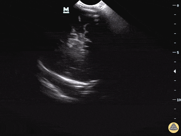 Clip 2: There is also asymmetry, specifically asymmetric ventricles with the left ventricle appearing larger than the right. 