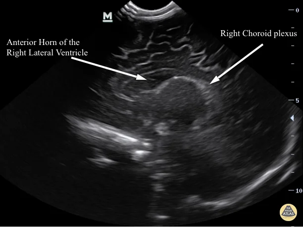 Cranial - Sagittal Right