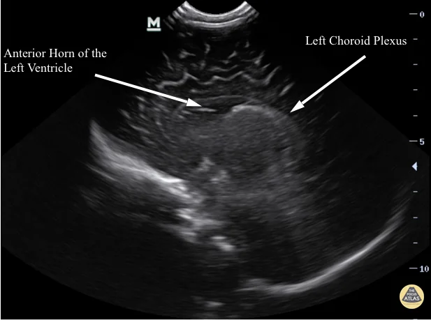 Cranial - Sagittal Left