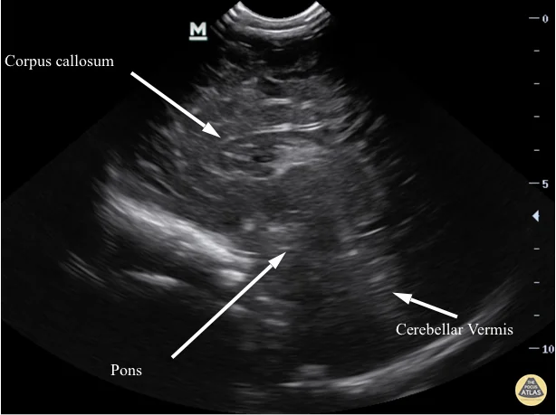 Cranial - Sagittal Midline
