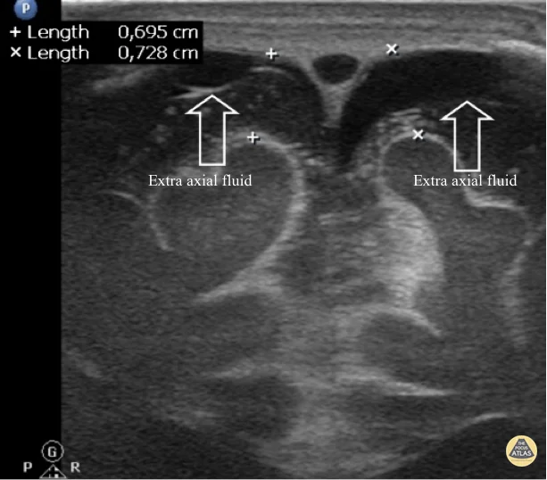Case - Hydrocephalus - Extra Axial Fluid - Labeled