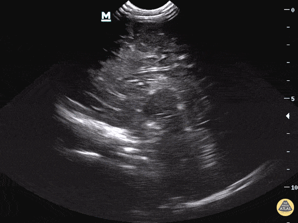 Hydrocephalus - Sagittal View