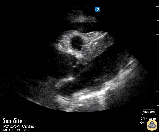 Aortic Dissection with Tamponade - Parasternal Long