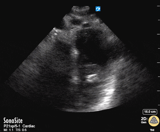 Aortic Dissection Suprasternal
