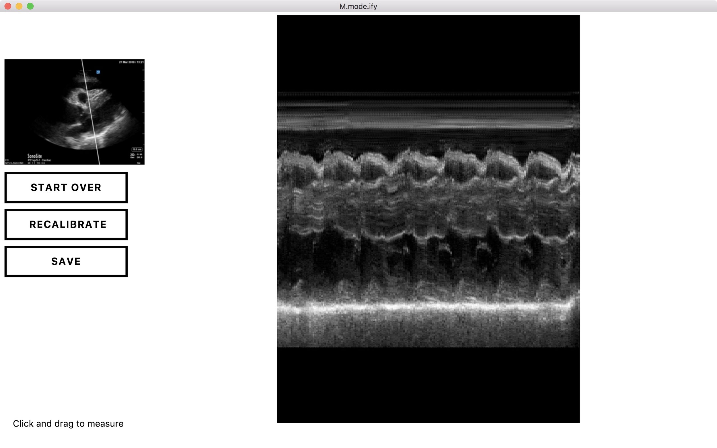 Aortic Dissection with Tamponade - M-mode
