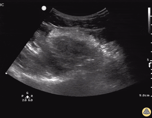 Ectopic - Ruptured Cornual Ectopic Pregnancy - Longitudinal