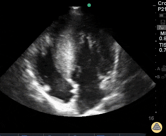 HOCM - Hypertrophic Obstructive Cardiomyopathy