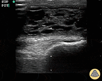Suprapatellar Bursitis