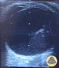 Posterior Vitreous Hemorrhage