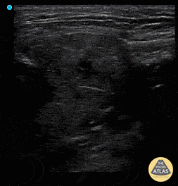 Sialadenitis