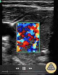 Thyroid Storm (Inferno Sign)