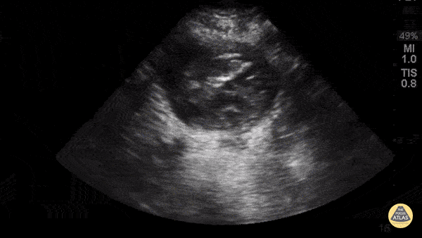 Aorta Posterior Wall Rupture