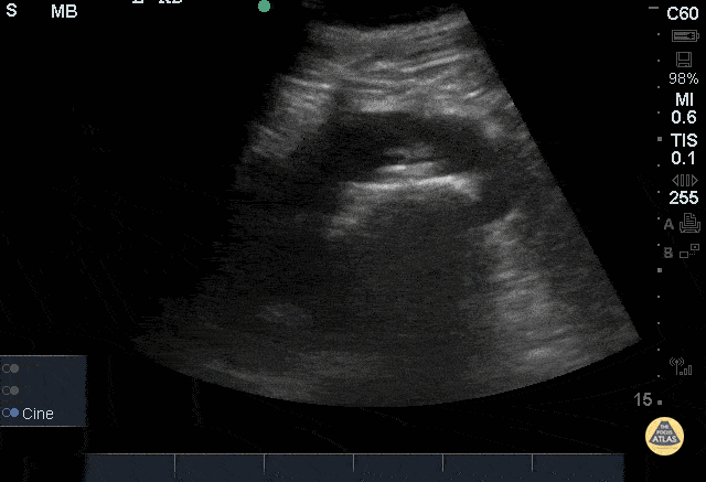 Staghorn Calculi