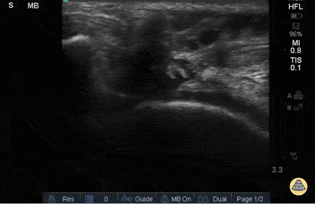 Right Patellar Tendon Rupture