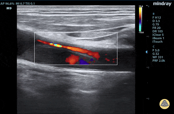 Aortic dissection flap tamponade color flow