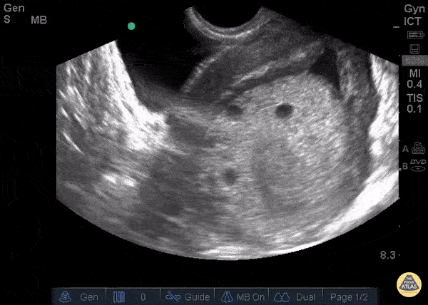 Molar Pregnancy