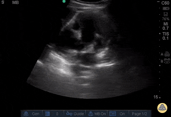 Severe Hydronephrosis - Congenital