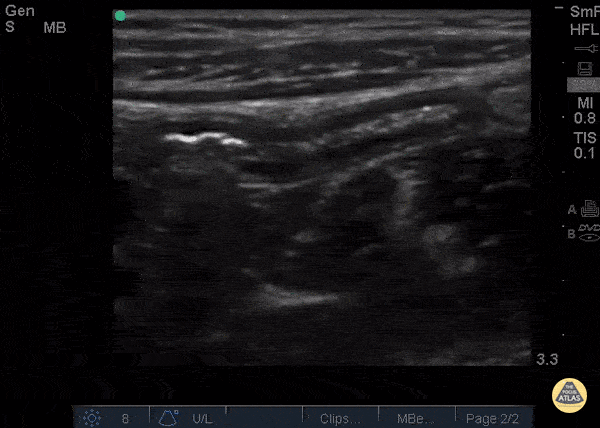 Normal Appendix blind end