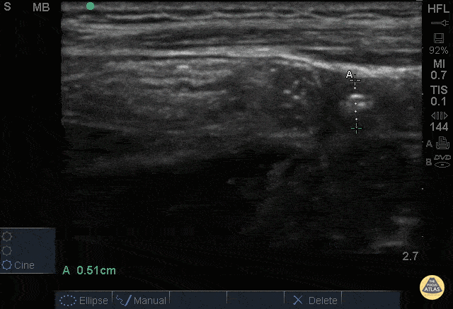 Normal Appendix - Cross Section Measured