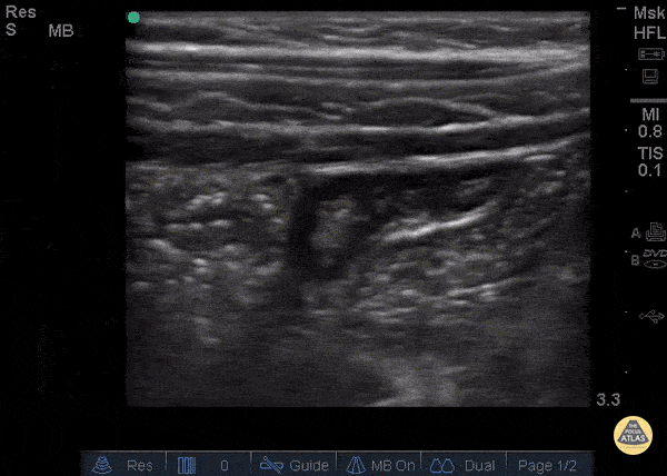 Normal Appendix - Blind End