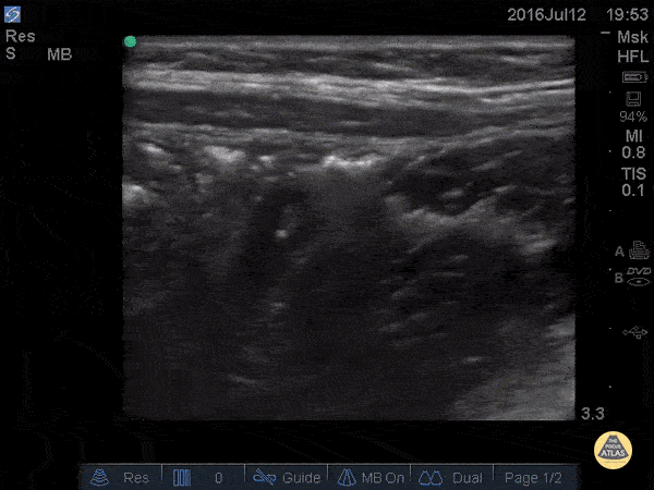 Normal Appendix - Cross Section