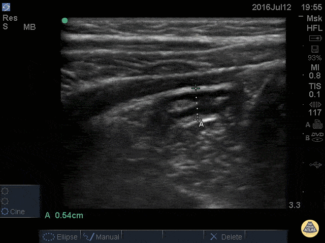 Normal Appendix - Cross Section Measured