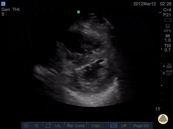 D-Sign in acute PE - Pre TPA