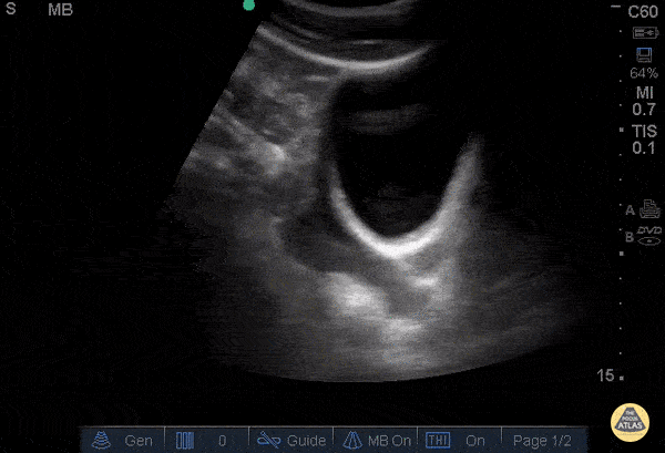 Positive FAST - Pelvis