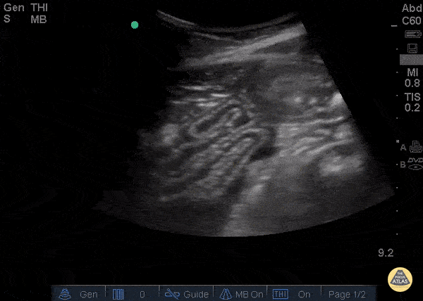 Free fluid and Collapsed Bowel