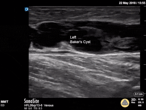Baker's Cyst