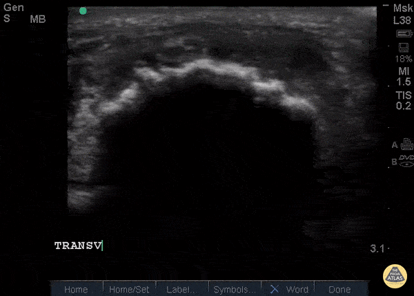 Patellar Tendon Rupture Transverse