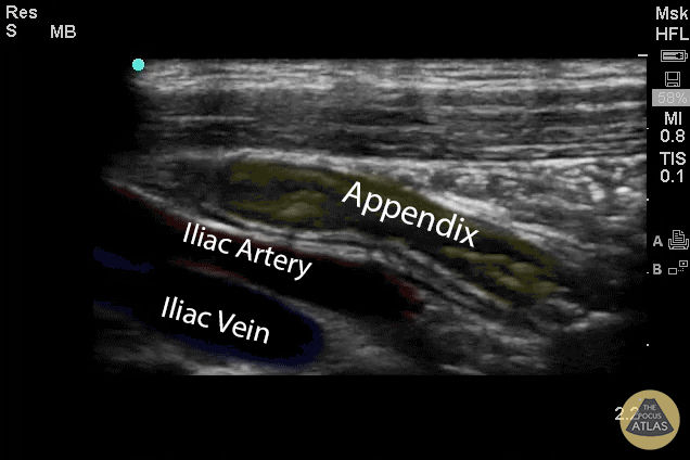 Bedside Ultrasound For Acute Appendicitis - Featuring Colorized Images
