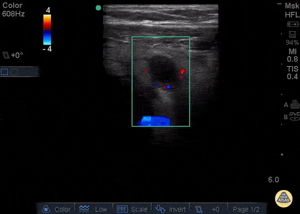 Ring of Fire - Increased vascularity visualized using color-flow Doppler known as "Ring of Fire."