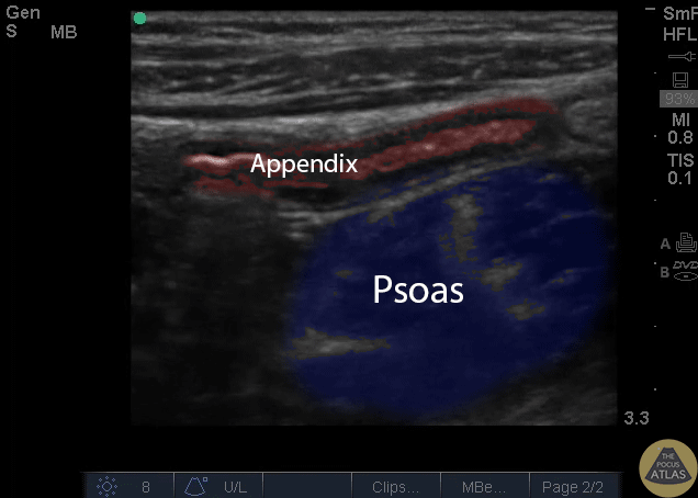 Labeled and Colorized Appendix and Psoas