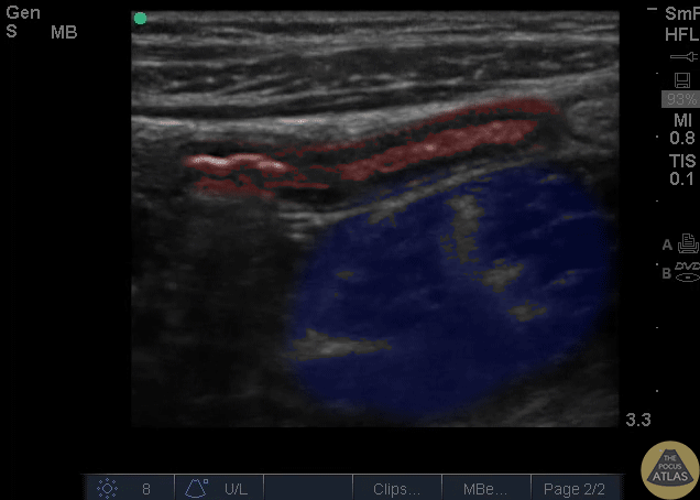 Colorized Appendix and Psoas